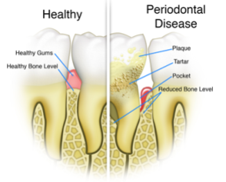 healthy_periodontitis